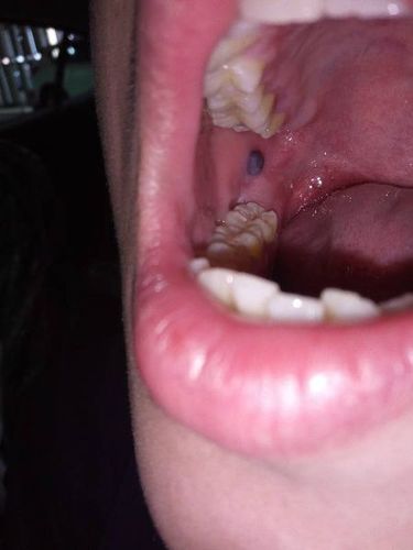嘴巴内壁挨着牙齿的地方长泡
